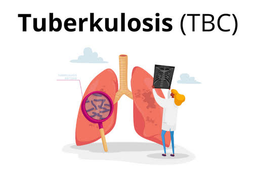 Ilustrasi Tuberkulosis