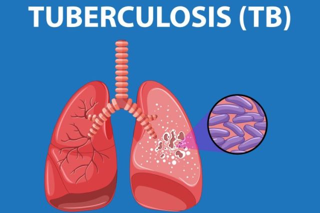 Kemenkes Sebut Kasus TBC Tinggi Karena Perbaikan Sistem Deteksi dan Pelaporan