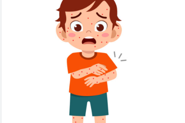 Kasus Campak Meningkat, Kemenkes Libatkan Sekolah Dorong Imunisasi Anak